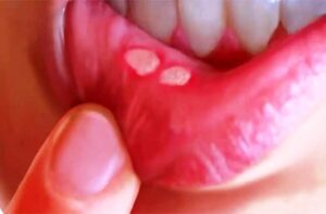 Mouth ulcer details in bengali