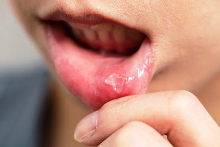 Mouth Ulcer treatment