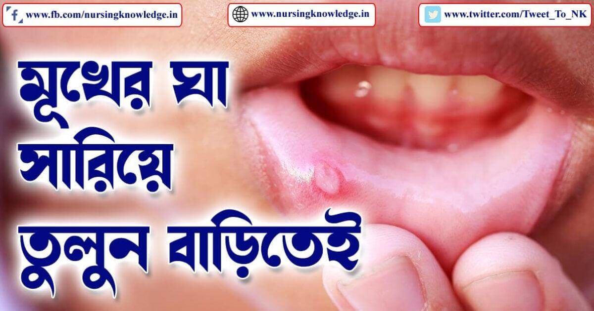 MOUTH ULCER (মুখের ঘা) TREATMENT IN BENGALI