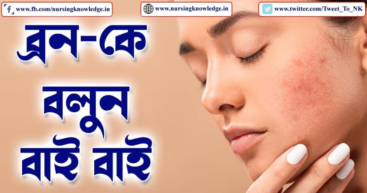 PIMPLE OR ACNE (ব্রণ) HOME TREATMENT IN BENGALI