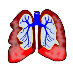 Asthma In Bengali