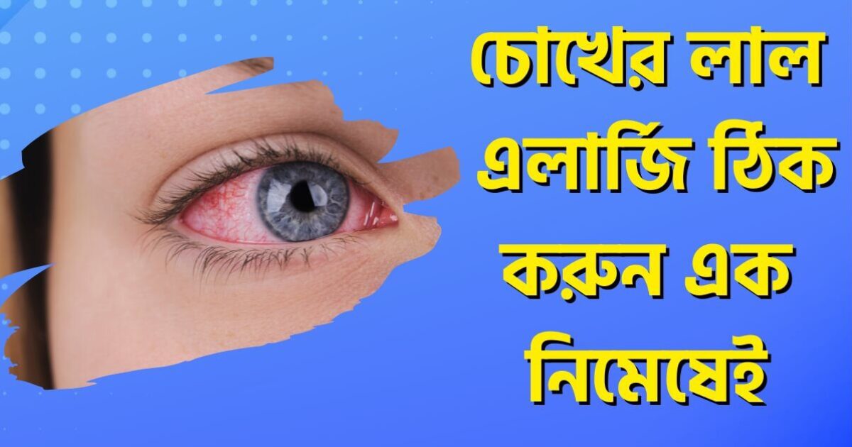 Best Eye Redness Allergy (চোখ ওঠা) Treatment at Home