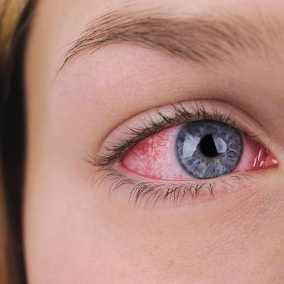 Eye Redness Disease