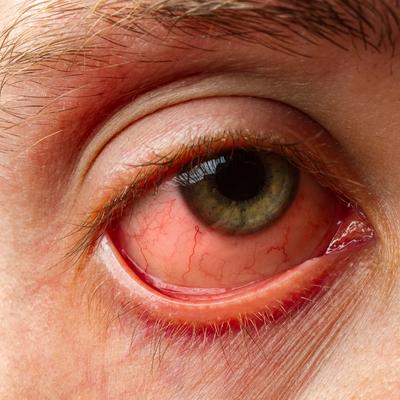Eye Redness Allergy Disease