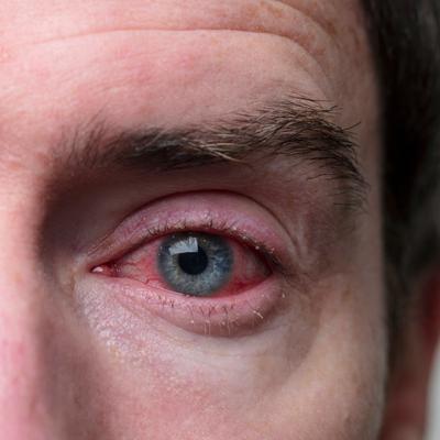 Symptoms Of Eye Redness Allergy Disease