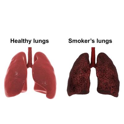 One Normal Lung And Another Affected The Cause Of Lung  Cancer