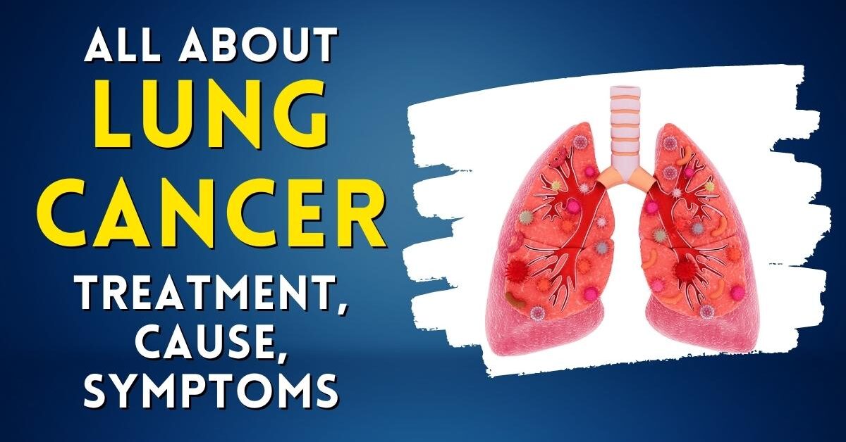 Top 5 Lung Cancer Treatment: Latest & Advanced