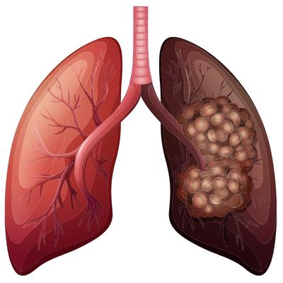 Normal Lung Vs Lung Cancer