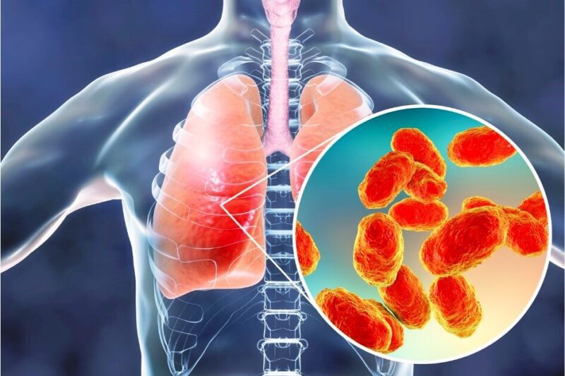 Best Treatments Of Pneumonia In The Lungs Infection Causes Virus Or Bacteria