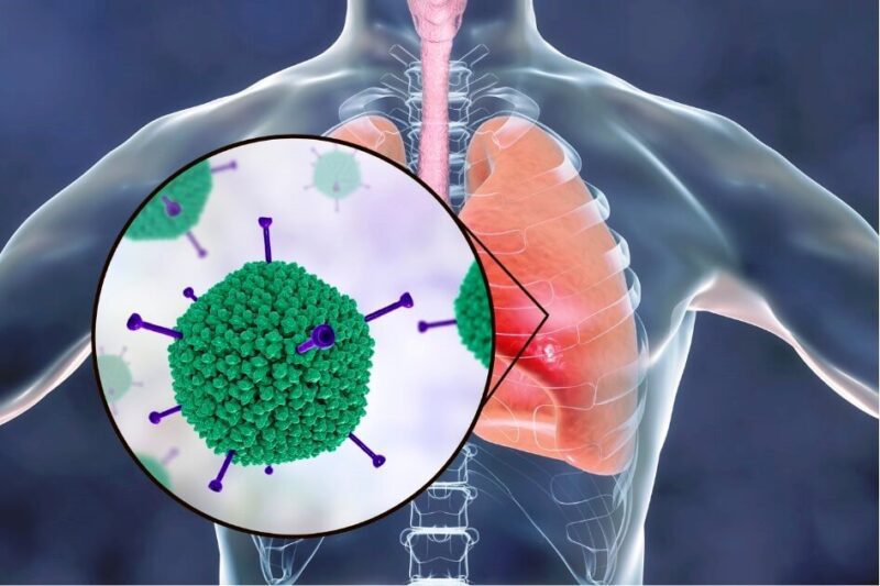 Causes Of Pneumonia In The Lungs Are Bacterial Or Viral Infection In The Respiratory Tract